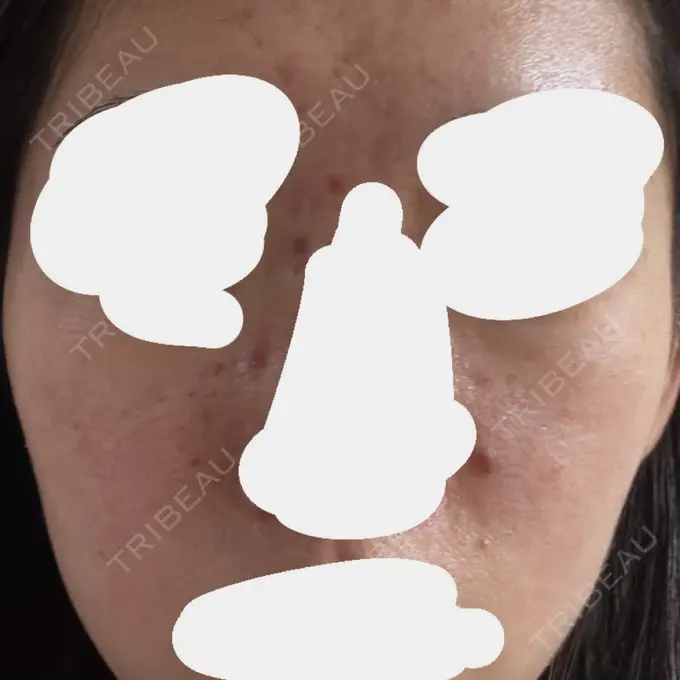 アグネス / ニキビ治療 日本ウェルネス再生クリニック DAY 0 メイン用