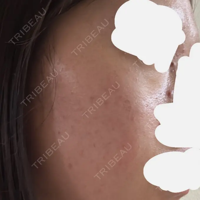 アグネス / ニキビ治療 日本ウェルネス再生クリニック DAY 0 メイン用