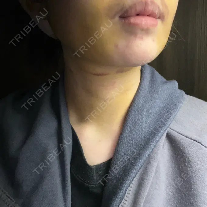 糸リフト / 脂肪吸引（顔） / ジョールファット除去 アリエル美容クリニック 横浜院 DAY 4 メイン用