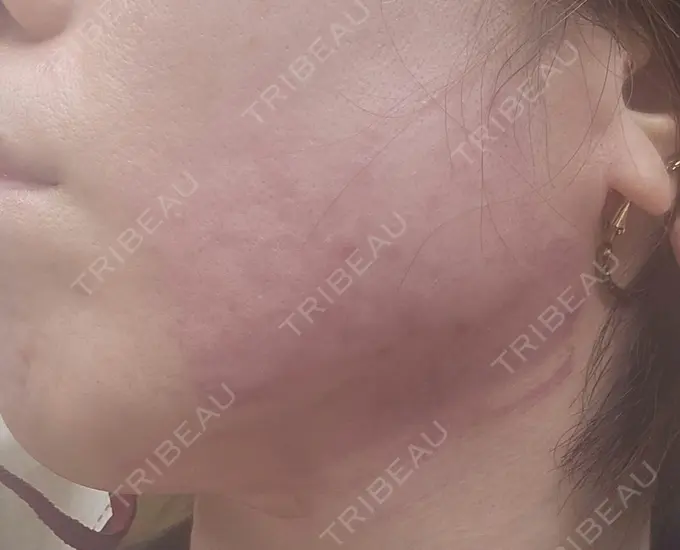 RF（高周波）たるみ治療 ゆきスキンクリニック 東池袋 DAY 0 メイン用