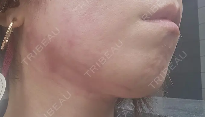 RF（高周波）たるみ治療 ゆきスキンクリニック 東池袋 DAY 0 メイン用