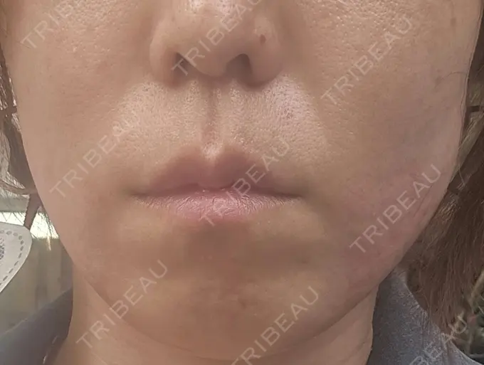 RF（高周波）たるみ治療 ゆきスキンクリニック 東池袋 DAY 0 メイン用