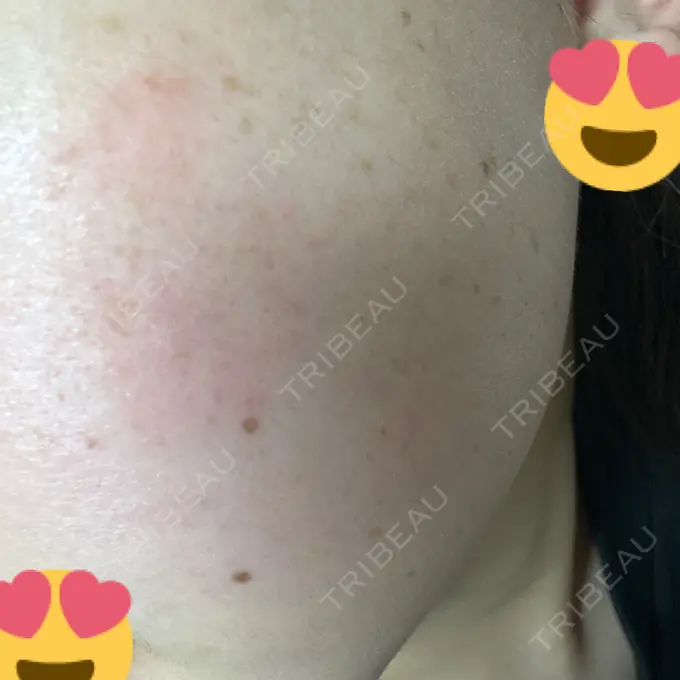 ボトックス（エラ・小顔） 共立美容外科 名古屋院 DAY 2 メイン用