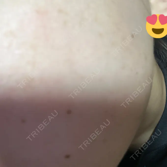 ボトックス（エラ・小顔） 共立美容外科 名古屋院 DAY 3 メイン用