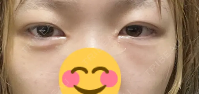 クマ治療 / ヒアルロン酸注入（目の下） BITO BEAUTY CLINIC DAY 2 メイン用