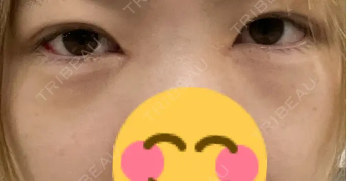 クマ治療 / ヒアルロン酸注入（目の下） BITO BEAUTY CLINIC DAY 3 メイン用