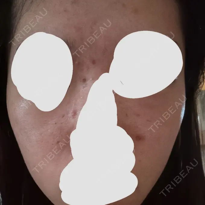 アグネス / ニキビ治療 日本ウェルネス再生クリニック DAY 1 メイン用