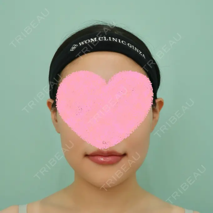 骨切り（あご） / 脂肪吸引（顔） WOM CLINIC GINZA （ワム クリニック ギンザ） DAY 14 メイン用