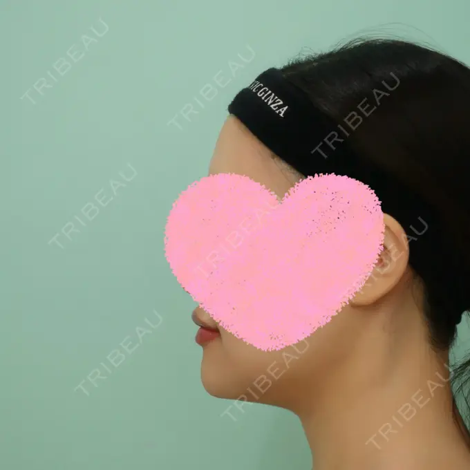 骨切り（あご） / 脂肪吸引（顔） WOM CLINIC GINZA （ワム クリニック ギンザ） DAY 14 メイン用