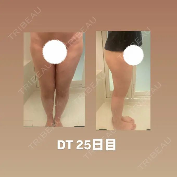 脂肪吸引（脚） 水の森美容クリニック 東京銀座院 DAY 25 メイン用