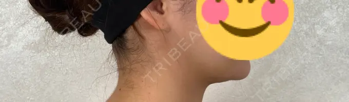 糸リフト / バッカルファット除去 / 脂肪吸引（顔） アリエル美容クリニック 横浜院 DAY 31 メイン用