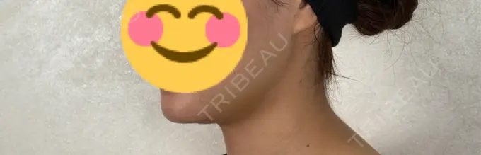 糸リフト / バッカルファット除去 / 脂肪吸引（顔） アリエル美容クリニック 横浜院 DAY 31 メイン用