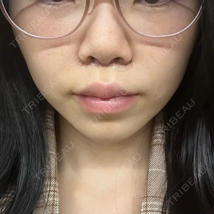 人中短縮 / ヒアルロン酸注入（目の下） / RF（高周波）たるみ治療 BITO BEAUTY CLINIC DAY 5 メイン用