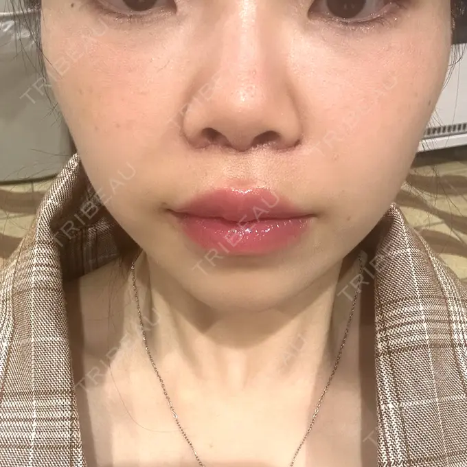 人中短縮 / ヒアルロン酸注入（目の下） / RF（高周波）たるみ治療 BITO BEAUTY CLINIC DAY 5 メイン用
