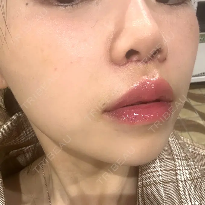 人中短縮 / ヒアルロン酸注入（目の下） / RF（高周波）たるみ治療 BITO BEAUTY CLINIC DAY 5 メイン用