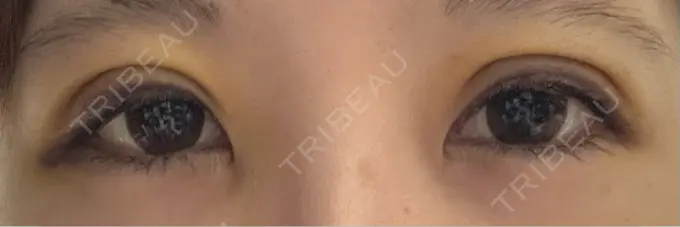 二重埋没 アリエル美容クリニック 水戸院 DAY 3 メイン用