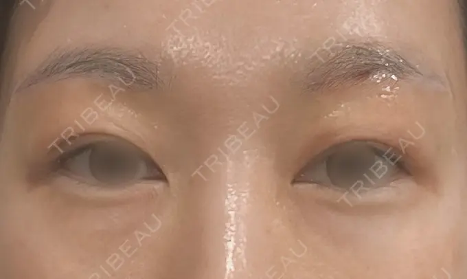 眉下切開 もとび美容外科クリニック 新宿院 DAY 3 メイン用