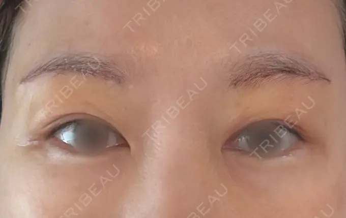 眉下切開 もとび美容外科クリニック 新宿院 DAY 4 メイン用