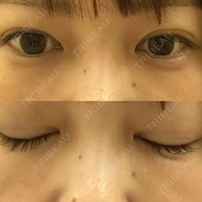 二重埋没 / 糸リフト アリエル美容クリニック 横浜院 DAY 5 メイン用