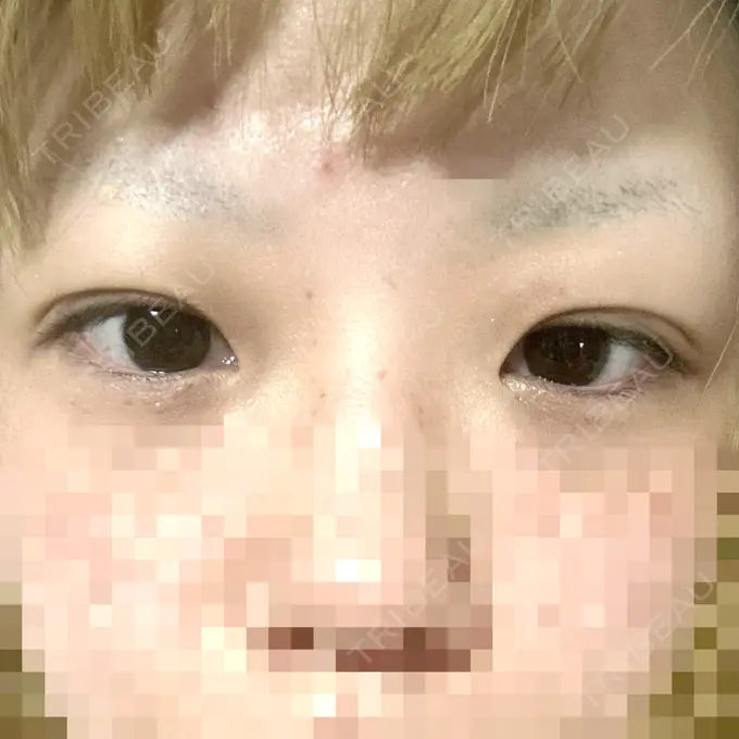 二重埋没 アリエル美容クリニック 横浜院 DAY 5 メイン用