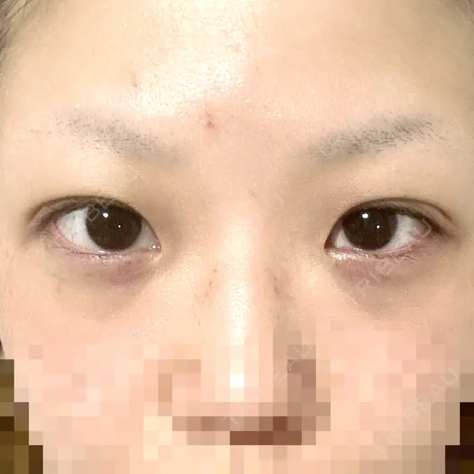 二重埋没 アリエル美容クリニック 横浜院 DAY 6 メイン用