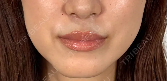 ボトックス（あご） / ヒアルロン酸注入（鼻翼基部） アリエル美容クリニック 横浜院 DAY 0 メイン用