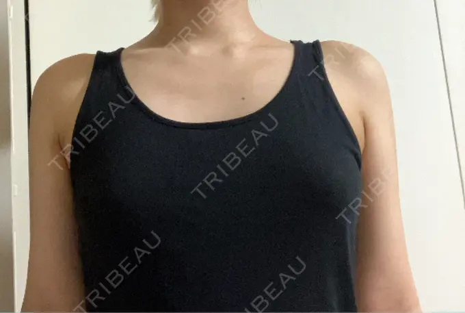 脂肪吸引（二の腕） 豊洲内科・糖尿病 / 形成・美容外科クリニック DAY 8 メイン用