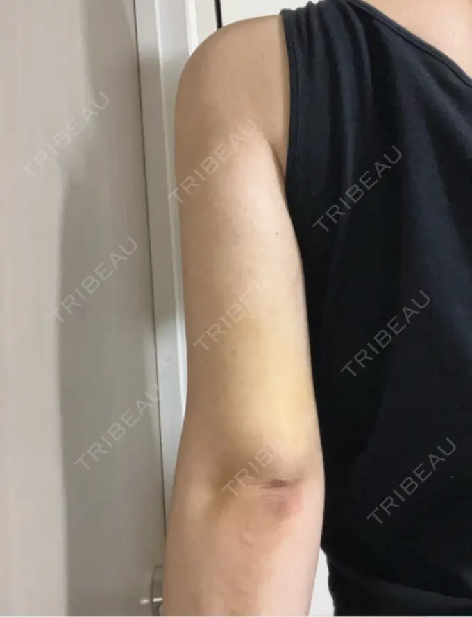 脂肪吸引（二の腕） 豊洲内科・糖尿病 / 形成・美容外科クリニック DAY 10 メイン用