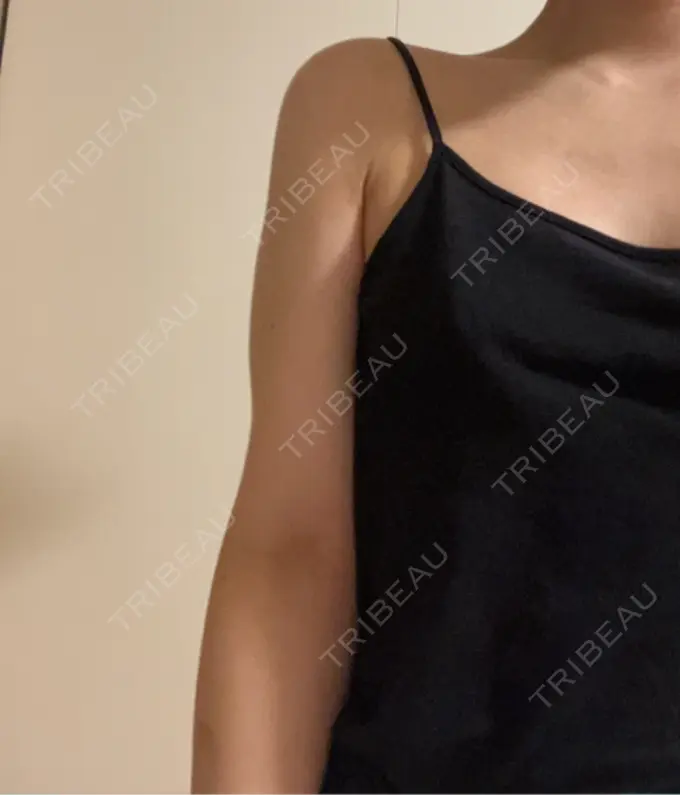 脂肪吸引（二の腕） 豊洲内科・糖尿病 / 形成・美容外科クリニック DAY 14 メイン用