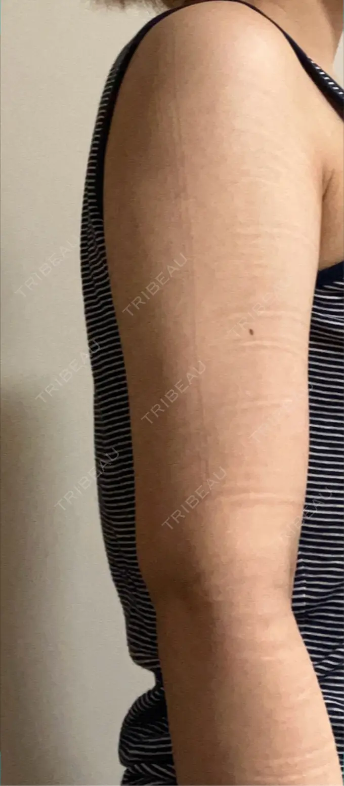 脂肪吸引（二の腕） 豊洲内科・糖尿病 / 形成・美容外科クリニック DAY 17 メイン用