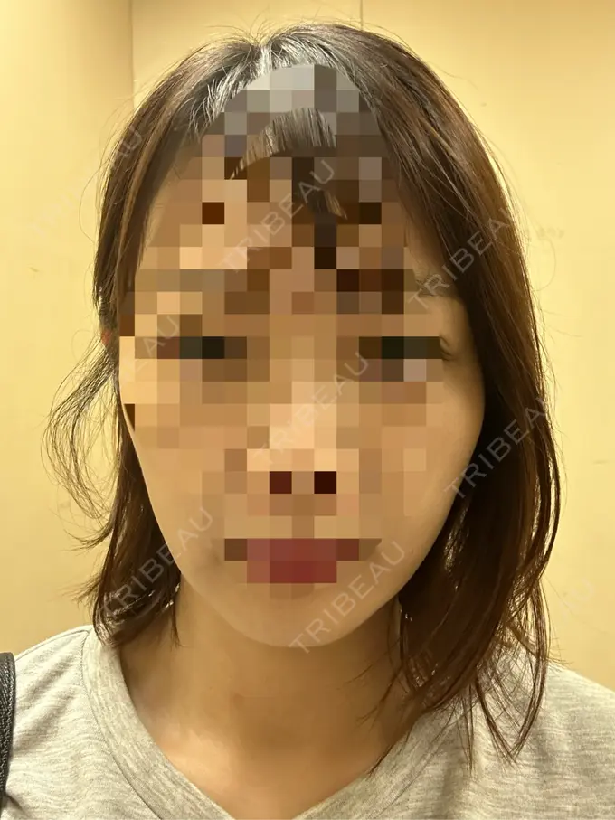 二重埋没 / 糸リフト アリエル美容クリニック 横浜院 DAY 5 メイン用