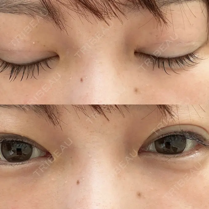 二重埋没 / 糸リフト アリエル美容クリニック 横浜院 DAY 6 メイン用