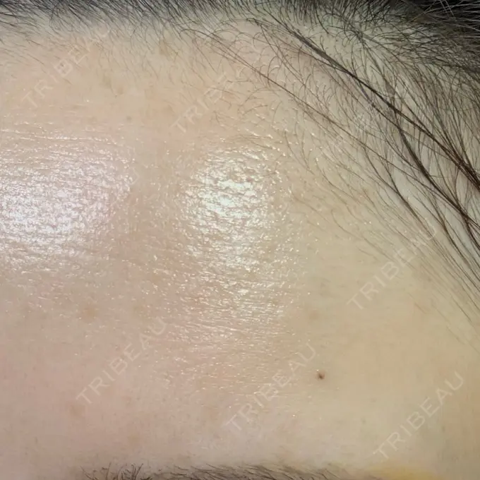 ルメッカ 東京美容外科 秋田院 DAY 1 メイン用