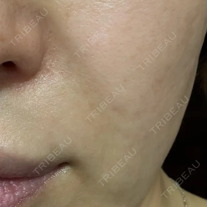 ルメッカ 東京美容外科 秋田院 DAY 1 メイン用