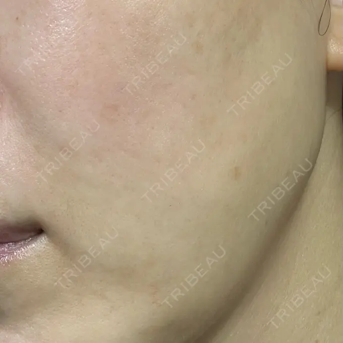 ルメッカ 東京美容外科 秋田院 DAY 1 メイン用