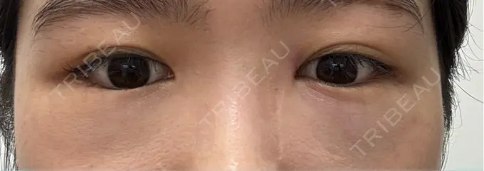 クマ治療 / 下まぶたの脂肪取り RIVER CLINIC（リバークリニック） DAY 1 メイン用