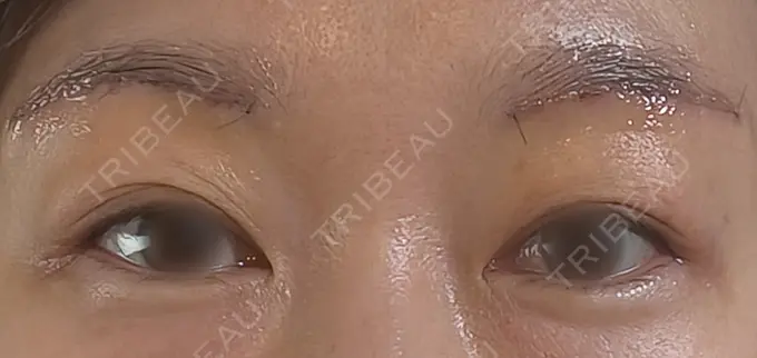 眉下切開 もとび美容外科クリニック 新宿院 DAY 5 メイン用