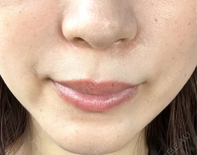 ボトックス（あご） / ヒアルロン酸注入（鼻翼基部） アリエル美容クリニック 横浜院 AFTER メイン用