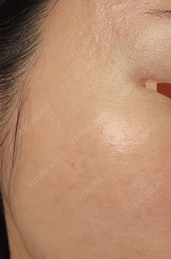 ニードルRF（ポテンツァなど） A CLINIC（エークリニック） 仙台院 DAY 29 メイン用