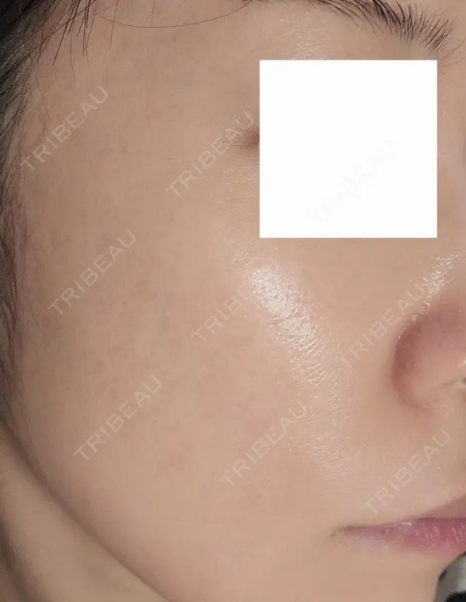 ニードルRF（ポテンツァなど） A CLINIC（エークリニック） 仙台院 AFTER メイン用