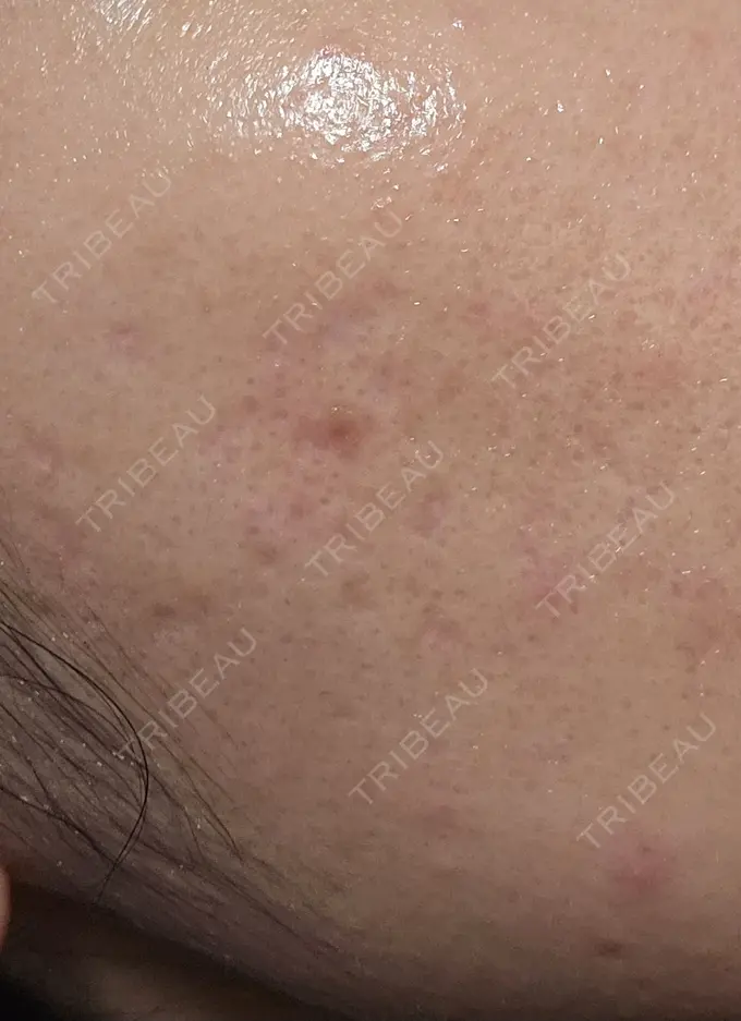 シミ取りレーザー 湘南美容クリニック 仙台院 AFTER メイン用