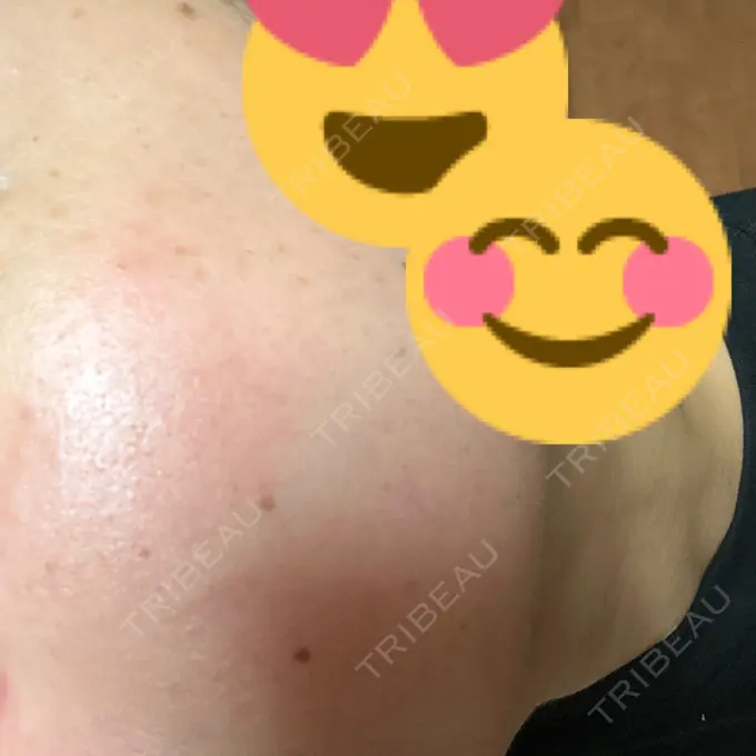 ボトックス（エラ・小顔） 共立美容外科 名古屋院 DAY 4 メイン用