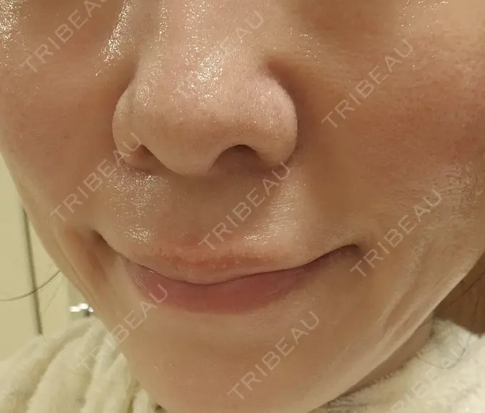 ショッピングリフト 湘南美容クリニック 仙台院 AFTER メイン用