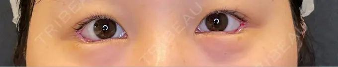 タレ目形成・グラマラスライン（切開） / タレ目形成・グラマラスライン（埋没） LOUIS CLINIC 二子玉川院【ルイクリニック】 DAY 0 メイン用