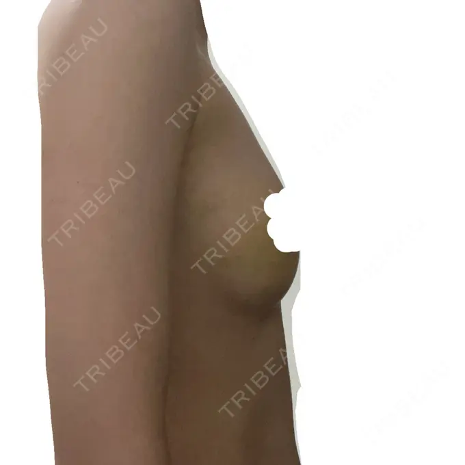 脂肪吸引（脚） / 豊胸（脂肪注入） / 胸修正 / 脂肪吸引（腰） Lipo Clinic omotesando DAY 9 メイン用