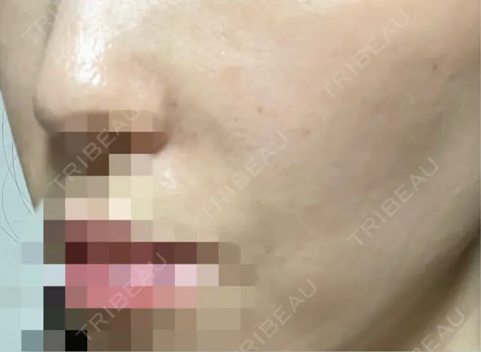 ヒアルロン酸注入（鼻翼基部） BiBiクリニック DAY 1 メイン用