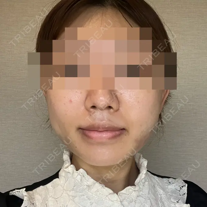 糸リフト / 脂肪吸引（顔） / 脂肪吸引注射（顔） ziz CLINIC DAY 0 メイン用