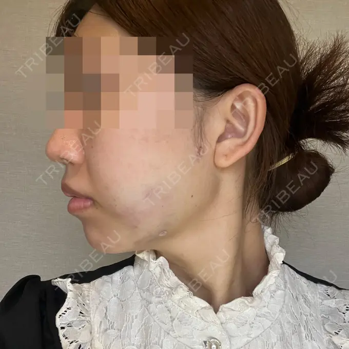 糸リフト / 脂肪吸引（顔） / 脂肪吸引注射（顔） ziz CLINIC DAY 0 メイン用