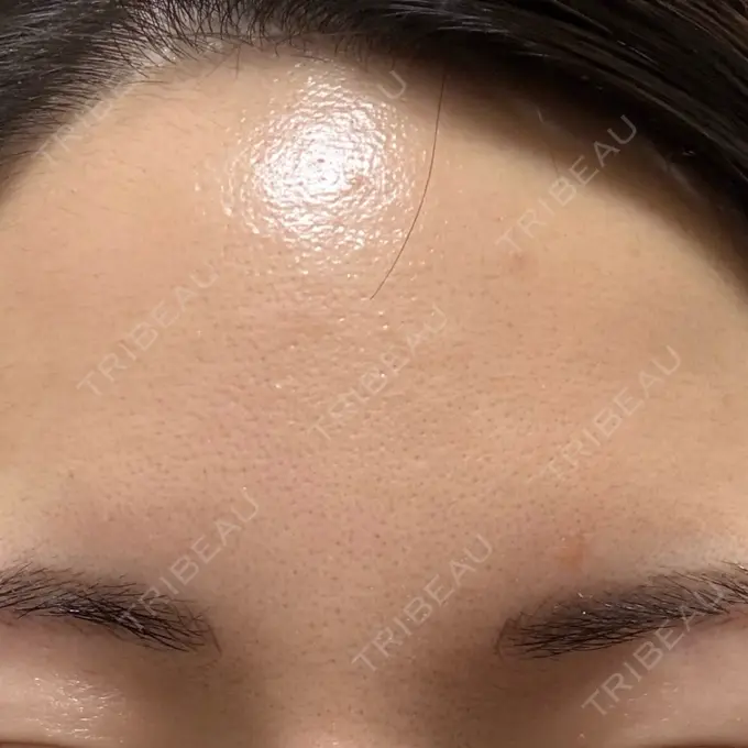 シワ取りボトックス 福岡TAクリニック DAY 13 メイン用