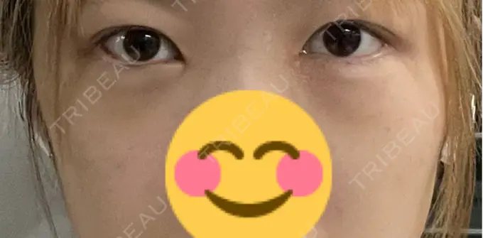 クマ治療 / ヒアルロン酸注入（目の下） BITO BEAUTY CLINIC DAY 4 メイン用